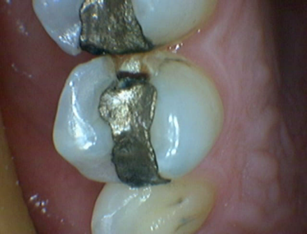 Broken amalgam filling with mercury in a premolar tooth
