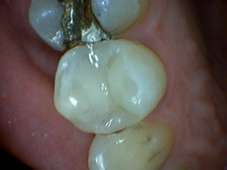 Newbury dentist Premolar tooth repaired with white composite filling by Dr. Alfie Chan